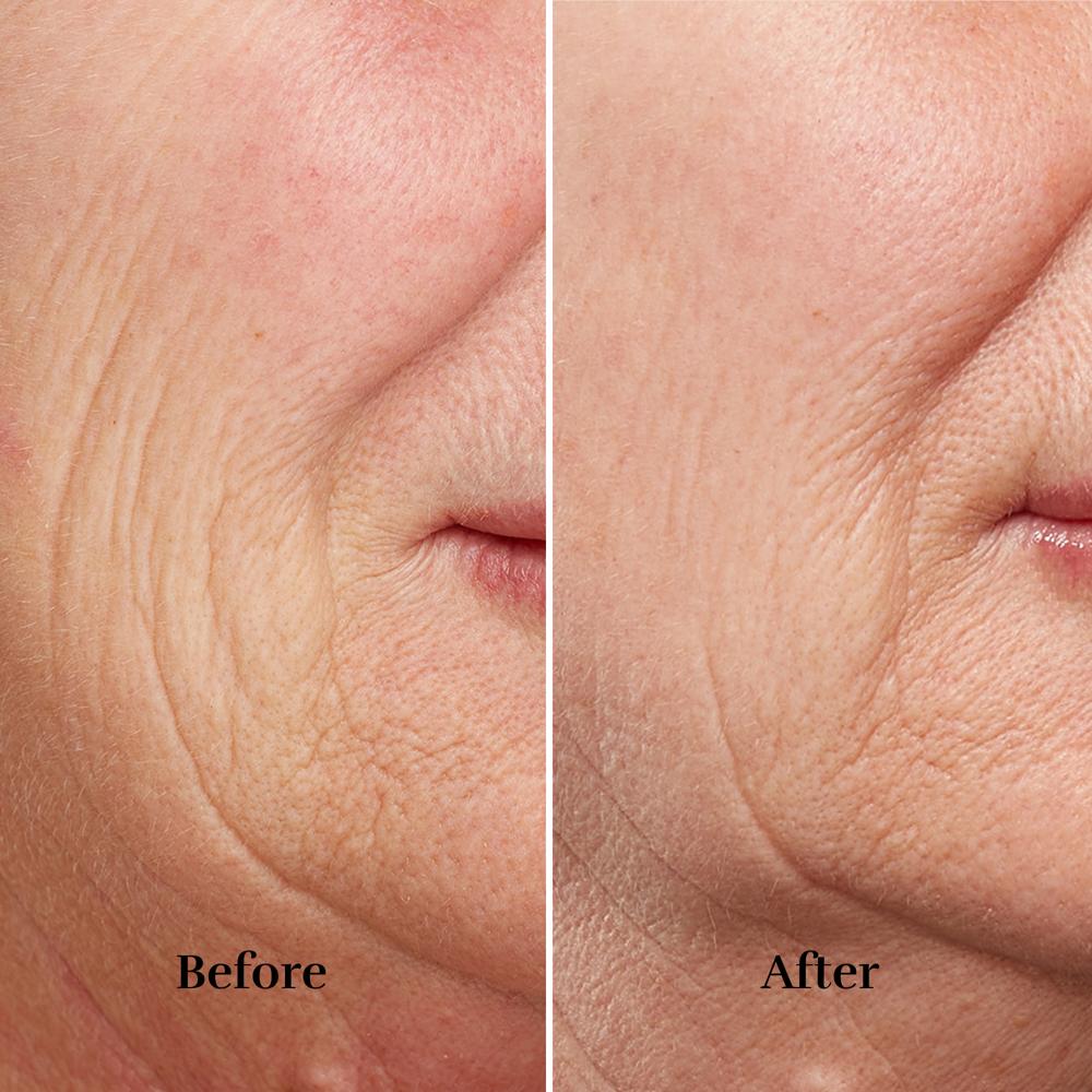 シルキン Silkn フェイスタイト リバイブ Silk'n Titan AllWays – Reduce wrinkles and improve skin structure