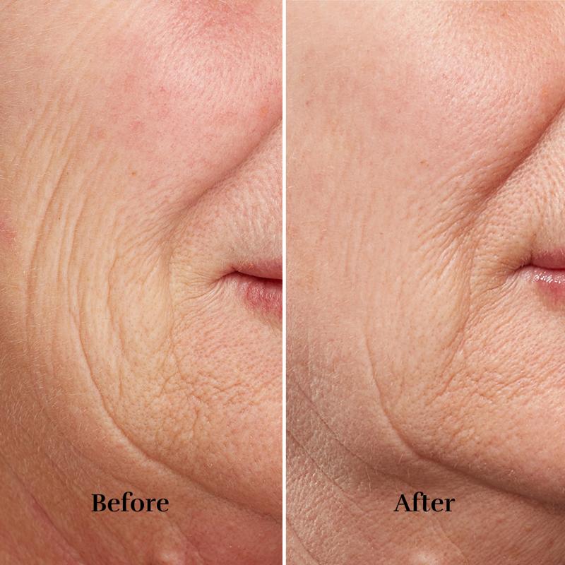 FaceTite Revive