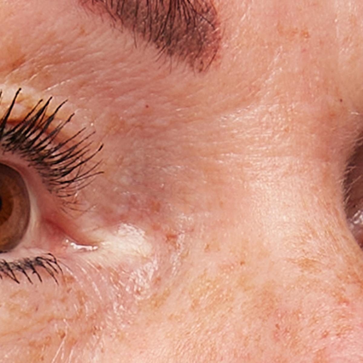 Treatment female age 49: FaceTite Mini, 15 minutes, 2 times a week for 12 weeks.