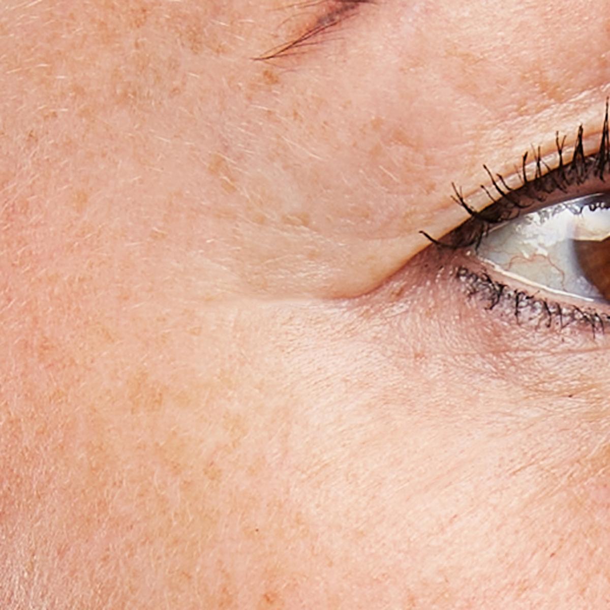 Treatment female age 49: FaceTite Mini, 15 minutes, 2 times a week for 12 weeks.