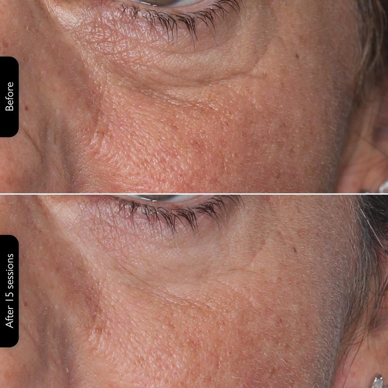 LED Face Mask 100