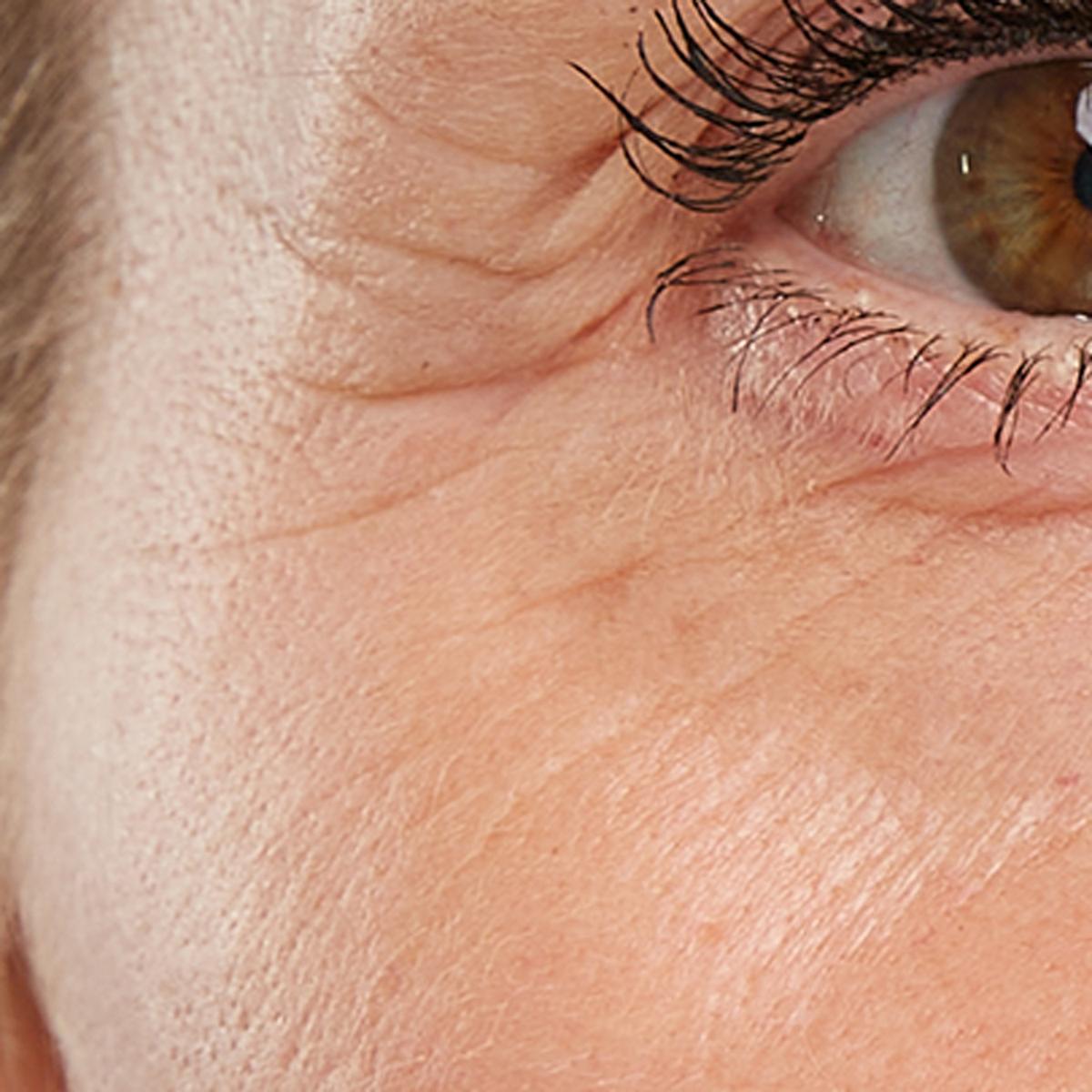 Treatment female age 52: FaceTite Mini, 15 minutes, 2-3 times a week for 8 weeks.