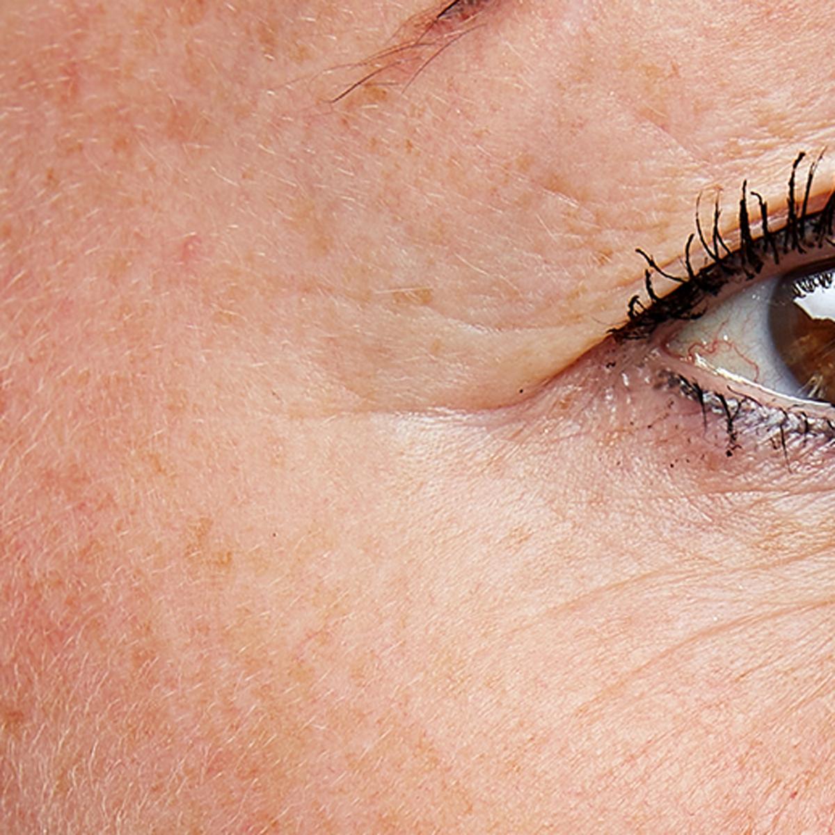 Treatment female age 52: FaceTite Mini, 15 minutes, 2-3 times a week for 8 weeks.