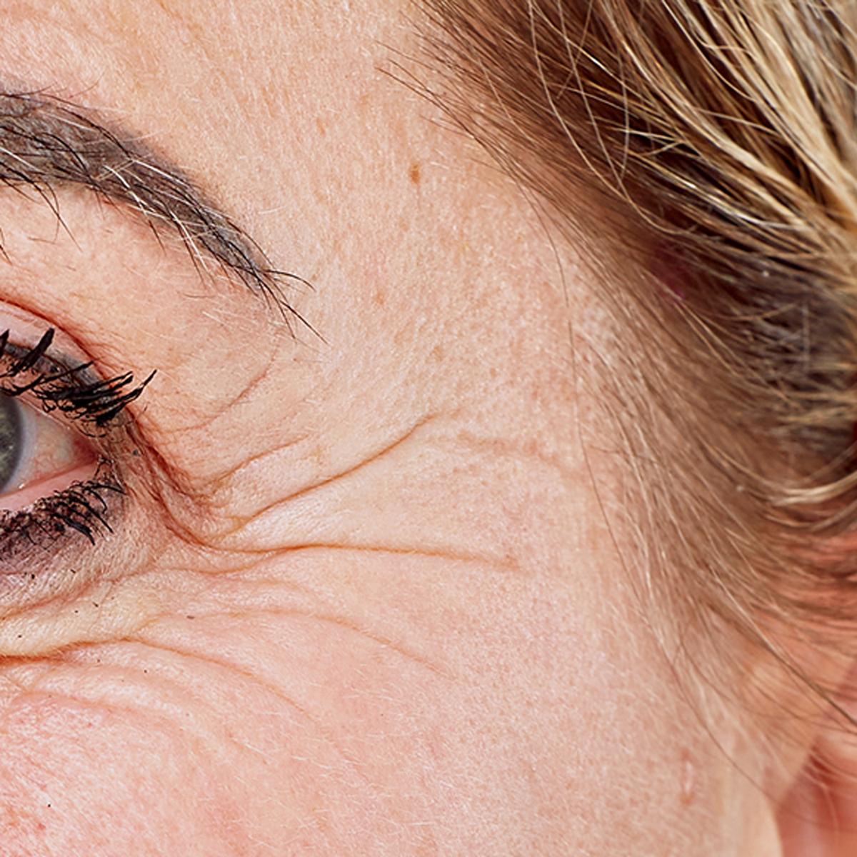 Treatment female age 52: FaceTite Mini, 15 minutes, 2-3 times a week for 8 weeks.